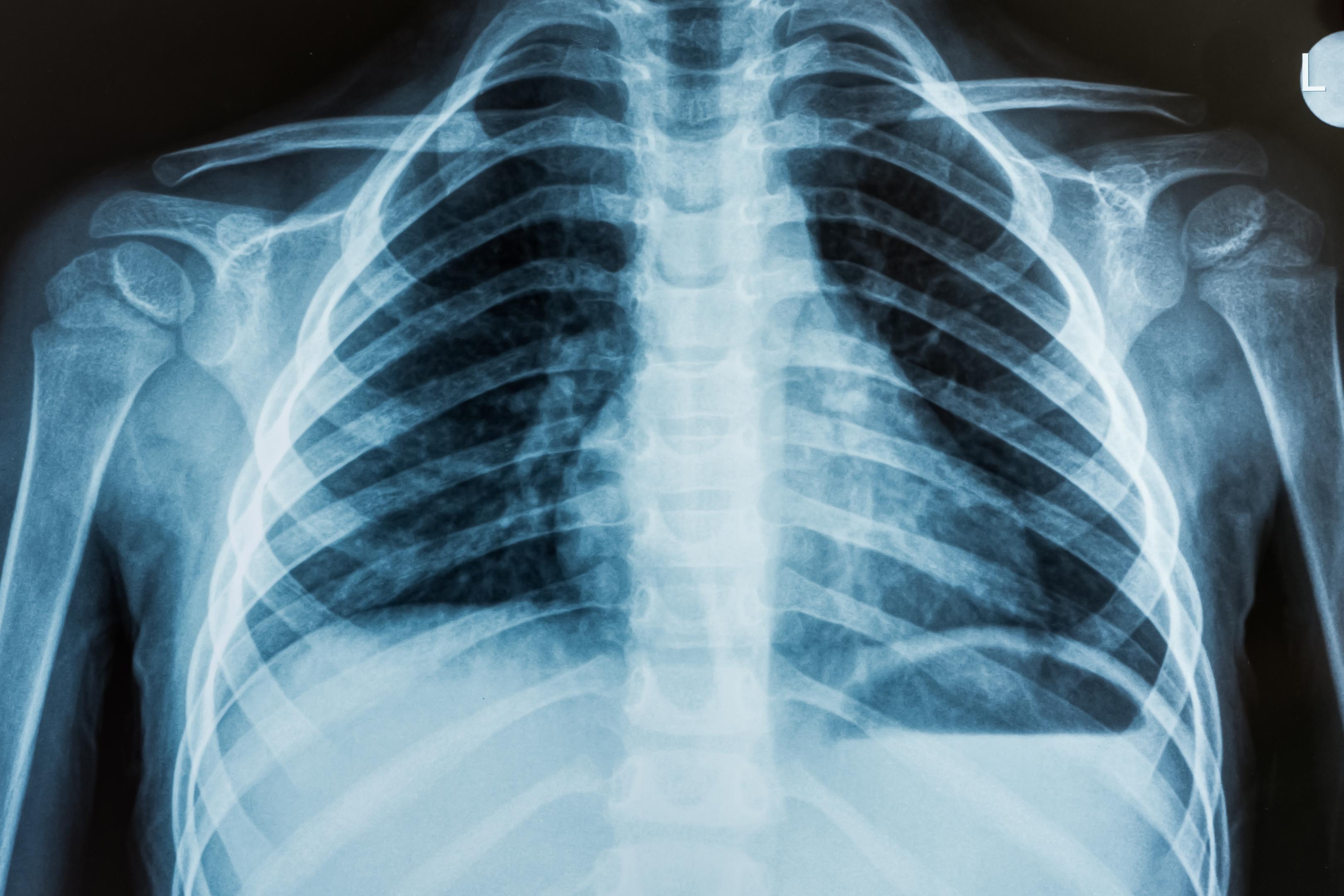 X-ray Example